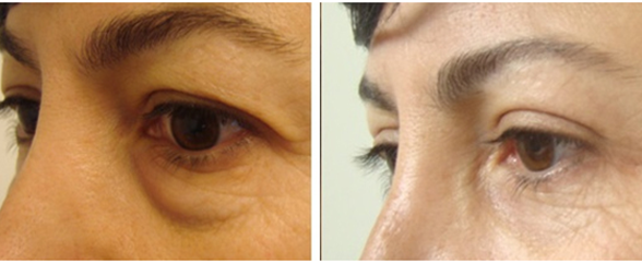 blefaroplastia barata tunisia